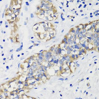 DEPTOR / DEPDC6 Antibody - Immunohistochemistry of paraffin-embedded Human breast cancer using DEPDC6 Polyclonal Antibody at dilution of 1:200 (40x lens).