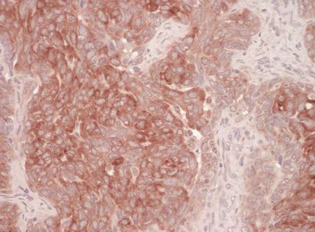 DERL1 / Derlin 1 Antibody - Detection of Human Derlin-1 by Immunohistochemistry. Sample: FFPE section of human ovarian carcinoma. Antibody: Affinity purified rabbit anti-Derlin-1 used at a dilution of 1:200 (1 ug/ml). Detection: Vector Laboratories ImmPACT NovaRED Peroxidase Substrate.