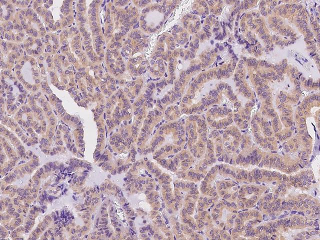 DERL2 / Derlin-2 Antibody - Immunochemical staining of human DERL2 in human thyroid carcinoma with rabbit polyclonal antibody at 1:500 dilution, formalin-fixed paraffin embedded sections.
