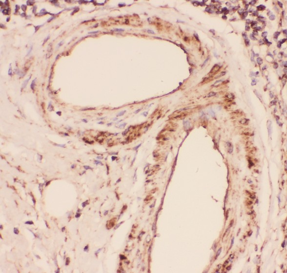 DES / Desmin Antibody - Desmin antibody IHC-paraffin: Human Intestinal Cancer Tissue.