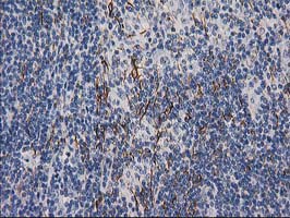 DES / Desmin Antibody - IHC of paraffin-embedded Human lymphoma tissue using anti-DES mouse monoclonal antibody. (Heat-induced epitope retrieval by 10mM citric buffer, pH6.0, 100C for 10min).