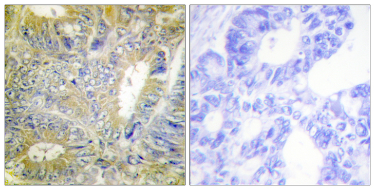 DES / Desmin Antibody - Immunohistochemistry analysis of paraffin-embedded human colon carcinoma tissue, using Desmin Antibody. The picture on the right is blocked with the synthesized peptide.