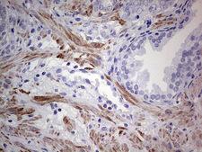 DES / Desmin Antibody - Immunohistochemical staining of paraffin-embedded Carcinoma of Human prostate tissue using anti-DES mouse monoclonal antibody.  heat-induced epitope retrieval by 1 mM EDTA in 10mM Tris, pH8.0, 120C for 3min)