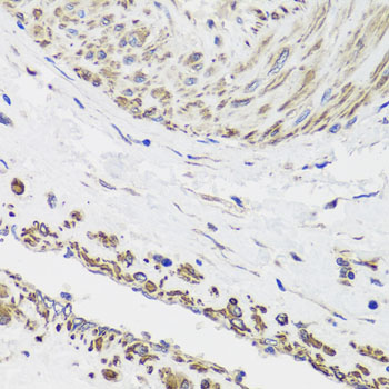 DES / Desmin Antibody - Immunohistochemistry of paraffin-embedded human prostate cancer using DES antibodyat dilution of 1:100 (40x lens).