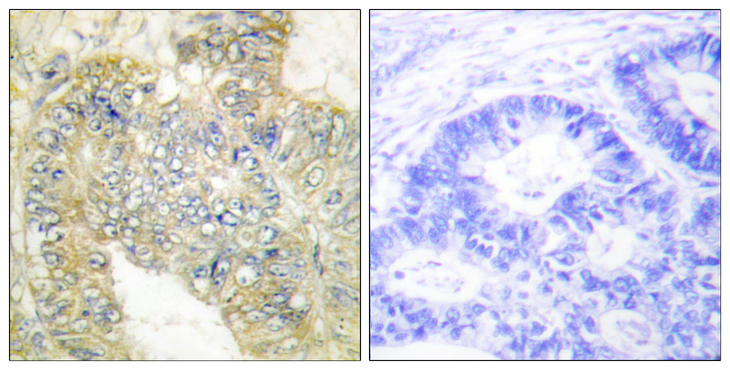 DES / Desmin Antibody - Immunohistochemistry analysis of paraffin-embedded human colon carcinoma, using Desmin (Phospho-Ser60) Antibody. The picture on the right is blocked with the phospho peptide.