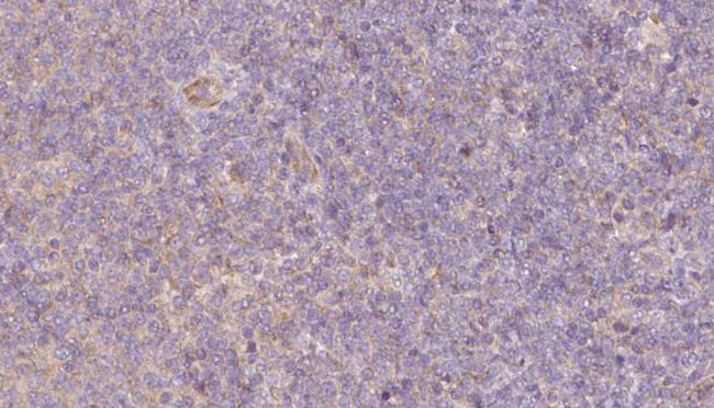 DESI2 / PPPDE1 Antibody - 1:100 staining human lymph carcinoma tissue by IHC-P. The sample was formaldehyde fixed and a heat mediated antigen retrieval step in citrate buffer was performed. The sample was then blocked and incubated with the antibody for 1.5 hours at 22°C. An HRP conjugated goat anti-rabbit antibody was used as the secondary.
