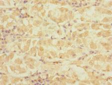 DET1 Antibody - Immunohistochemistry of paraffin-embedded human gastric cancer at dilution 1:100