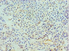 DFFA / ICAD / DFF45 Antibody - Immunohistochemistry of paraffin-embedded human breast cancer using antibody at 1:100 dilution.