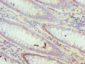 DFFA / ICAD / DFF45 Antibody - Immunohistochemistry of paraffin-embedded human colon cancer using antibody at 1:100 dilution.