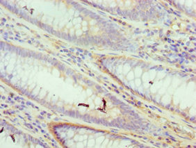DFFA / ICAD / DFF45 Antibody - Immunohistochemistry of paraffin-embedded human colon cancer using DFFA Antibody at dilution of 1:100