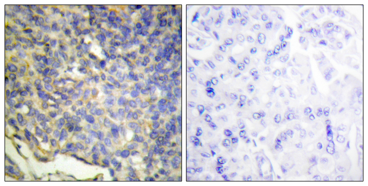 DFFA / ICAD / DFF45 Antibody - Immunohistochemistry analysis of paraffin-embedded human breast carcinoma tissue, using DFFA Antibody. The picture on the right is blocked with the synthesized peptide.