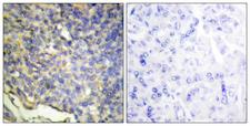 DFFA / ICAD / DFF45 Antibody - Immunohistochemistry analysis of paraffin-embedded human breast carcinoma tissue, using DFFA Antibody. The picture on the right is blocked with the synthesized peptide.
