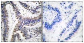 DFFA / ICAD / DFF45 Antibody - IHC of paraffin-embedded human lung carcinoma, using DFF45 (Cleaved-Asp224) Antibody. The picture on the right is treated with the synthesized peptide.
