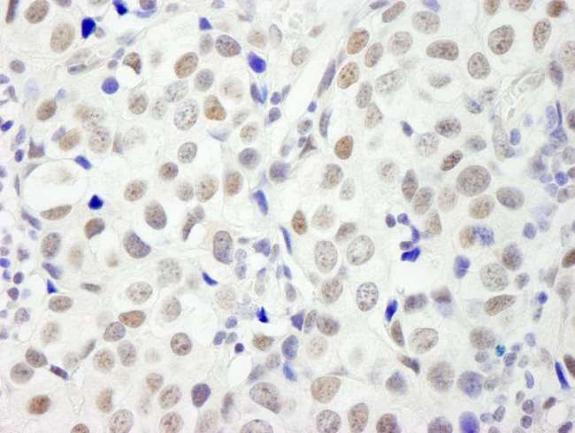 DFFA / ICAD / DFF45 Antibody - Detection of Human DFF45/DFFA by Immunohistochemistry. Sample: FFPE section of human breast carcinoma. Antibody: Affinity purified rabbit anti-DFF45/DFFA used at a dilution of 1:500.