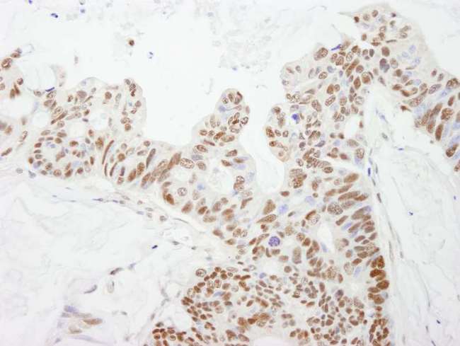 DFFA / ICAD / DFF45 Antibody - Detection of Human DFF45/DFFA by Immunohistochemistry. Sample: FFPE section of human ovarian carcinoma. Antibody: Affinity purified rabbit anti-DFF45/DFFA used at a dilution of 1:100.