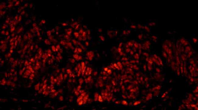 DFFA / ICAD / DFF45 Antibody - Detection of Human DFF45/DFFA by Immunofluorescence. Sample: FFPE section of human ovarian carcinoma. Antibody: Affinity purified rabbit anti-DFF45/DFFA used at a dilution of 1:100. Detection: Red-fluorescent goat anti-rabbit IgG highly cross-adsorbed Antibody used at a dilution of 1:100.