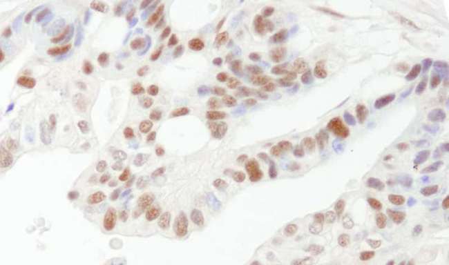 DFFA / ICAD / DFF45 Antibody - Detection of Human DFF45/DFFA by Immunohistochemistry. Sample: FFPE section of human ovarian carcinoma. Antibody: Affinity purified rabbit anti-DFF45/DFFA used at a dilution of 1:200 (1 ug/ml). Detection: DAB.