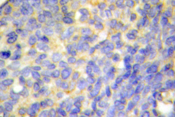 DFFA / ICAD / DFF45 Antibody - IHC of ICAD (Q177) pAb in paraffin-embedded human breast carcinoma tissue.