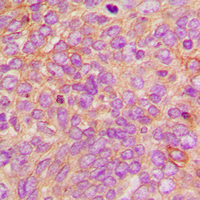 DFFA / ICAD / DFF45 Antibody - Immunohistochemical analysis of DFF45 staining in human breast cancer formalin fixed paraffin embedded tissue section. The section was pre-treated using heat mediated antigen retrieval with sodium citrate buffer (pH 6.0). The section was then incubated with the antibody at room temperature and detected using an HRP conjugated compact polymer system. DAB was used as the chromogen. The section was then counterstained with hematoxylin and mounted with DPX.