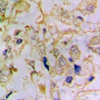DFFA / ICAD / DFF45 Antibody - Immunohistochemical analysis of DFF45 staining in human lung cancer formalin fixed paraffin embedded tissue section. The section was pre-treated using heat mediated antigen retrieval with sodium citrate buffer (pH 6.0). The section was then incubated with the antibody at room temperature and detected using an HRP conjugated compact polymer system. DAB was used as the chromogen. The section was then counterstained with haematoxylin and mounted with DPX.