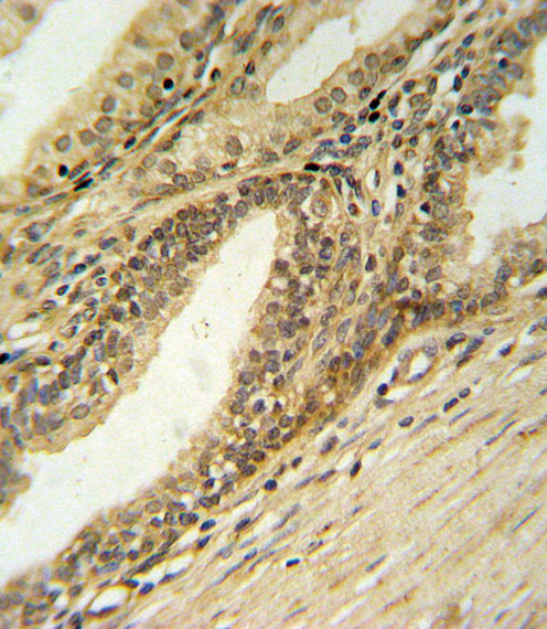 DFFB Antibody - DFFB Antibody IHC of formalin-fixed and paraffin-embedded prostate carcinoma followed by peroxidase-conjugated secondary antibody and DAB staining.
