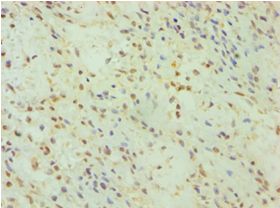 DFNA5 Antibody - Immunohistochemistry of paraffin-embedded human breast cancer using antibody at 1:100 dilution.