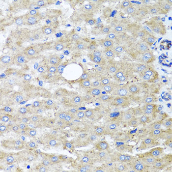 DFNA5 Antibody - Immunohistochemistry of paraffin-embedded human liver injury tissue.