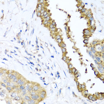 DFNA5 Antibody - Immunohistochemistry of paraffin-embedded human lung cancer tissue.