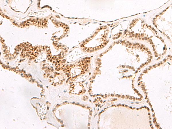 DGCR6L Antibody - Immunohistochemistry of paraffin-embedded Human thyroid cancer tissue  using DGCR6L Polyclonal Antibody at dilution of 1:65(×200)