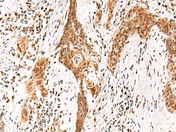 DGCR6L Antibody - Immunohistochemistry of paraffin-embedded Human esophagus cancer tissue  using DGCR6L Polyclonal Antibody at dilution of 1:65(×200)
