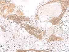 DGCR6L Antibody - Immunohistochemistry of paraffin-embedded Human esophagus cancer tissue  using DGCR6L Polyclonal Antibody at dilution of 1:70(×200)