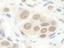 DGCR8 Antibody - Detection of Human DGCR8 by Immunohistochemistry. Sample: FFPE section of human breast carcinoma. Antibody: Affinity purified rabbit anti-DGCR8 used at a dilution of 1:250.