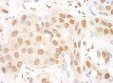 DGCR8 Antibody - Detection of Human DGCR8 by Immunohistochemistry. Sample: FFPE section of human breast carcinoma. Antibody: Affinity purified rabbit anti-DGCR8 used at a dilution of 1:200 (1 ug/ml). Detection: DAB.