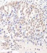 DGCR8 Antibody - Detection of Human DGCR8 by Immunohistochemistry. Sample: FFPE section of human ovarian carcinoma. Antibody: Affinity purified rabbit anti-DGCR8 used at a dilution of 1:1000 (1 ug/ml). Detection: DAB.