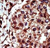 DGK-IOTA / DGKI Antibody - Formalin-fixed and paraffin-embedded human cancer tissue reacted with the primary antibody, which was peroxidase-conjugated to the secondary antibody, followed by AEC staining. This data demonstrates the use of this antibody for immunohistochemistry; clinical relevance has not been evaluated. BC = breast carcinoma; HC = hepatocarcinoma.
