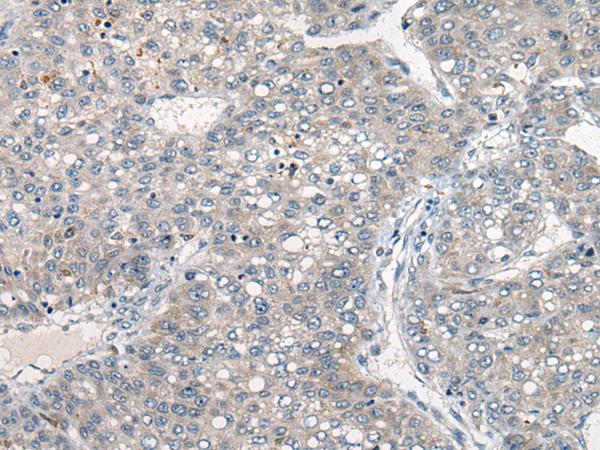 DGK-IOTA / DGKI Antibody - Immunohistochemistry of paraffin-embedded Human liver cancer tissue  using DGKI Polyclonal Antibody at dilution of 1:80(×200)