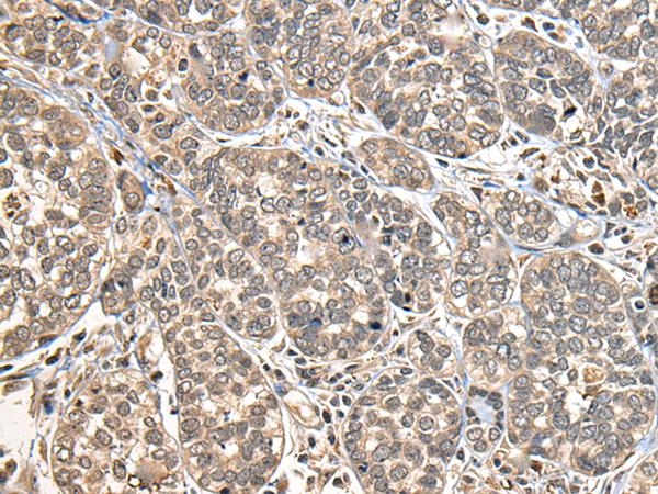 DGK-IOTA / DGKI Antibody - Immunohistochemistry of paraffin-embedded Human esophagus cancer tissue  using DGKI Polyclonal Antibody at dilution of 1:30(×200)