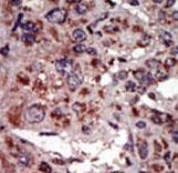 DGKA Antibody - Formalin-fixed and paraffin-embedded human cancer tissue reacted with the primary antibody, which was peroxidase-conjugated to the secondary antibody, followed by AEC staining. This data demonstrates the use of this antibody for immunohistochemistry; clinical relevance has not been evaluated. BC = breast carcinoma; HC = hepatocarcinoma.