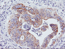 DGKA Antibody - IHC of paraffin-embedded Carcinoma of Human pancreas tissue using anti-DGKA mouse monoclonal antibody.