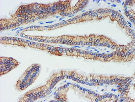 DGKA Antibody - IHC of paraffin-embedded Carcinoma of Human prostate tissue using anti-DGKA mouse monoclonal antibody.