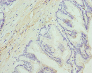 DGKA Antibody - Immunohistochemistry of paraffin-embedded human prostate cancer at dilution 1:100