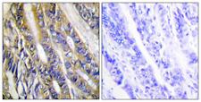 DGKeta / DGKH Antibody - Immunohistochemistry analysis of paraffin-embedded human colon carcinoma tissue, using DGKH Antibody. The picture on the right is blocked with the synthesized peptide.