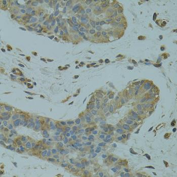 DGKQ Antibody - Immunohistochemistry of paraffin-embedded Human breast cancer using DGKQ Polyclonal Antibody at dilution of 1:100 (40x lens).