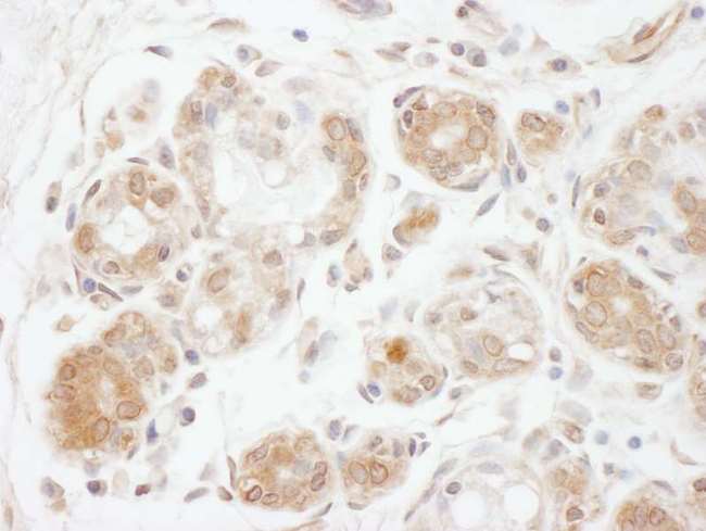 DGKZ Antibody - Detection of Human DGK zeta by Immunohistochemistry. Sample: FFPE section of human breast carcinoma. Antibody: Affinity purified rabbit anti-DGK zeta used at a dilution of 1:1000 (1 ug/ml). Detection: DAB.