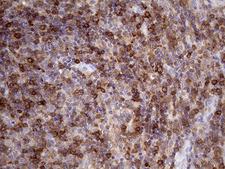 DGKZ Antibody - Immunohistochemical staining of paraffin-embedded Human lymphoma tissue using anti-DGKZ mouse monoclonal antibody. (Heat-induced epitope retrieval by 1mM EDTA in 10mM Tris buffer. (pH8.5) at 120°C for 3 min. (1:500)