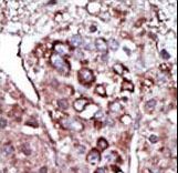 DGKZ Antibody - Formalin-fixed and paraffin-embedded human cancer tissue reacted with the primary antibody, which was peroxidase-conjugated to the secondary antibody, followed by AEC staining. This data demonstrates the use of this antibody for immunohistochemistry; clinical relevance has not been evaluated. BC = breast carcinoma; HC = hepatocarcinoma.
