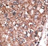 DHAND / HAND2 Antibody - Formalin-fixed and paraffin-embedded human cancer tissue reacted with the primary antibody, which was peroxidase-conjugated to the secondary antibody, followed by AEC staining. This data demonstrates the use of this antibody for immunohistochemistry; clinical relevance has not been evaluated. BC = breast carcinoma; HC = hepatocarcinoma.