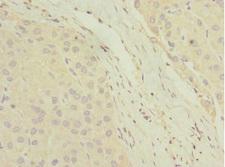 DHAND / HAND2 Antibody - Immunohistochemistry of paraffin-embedded human liver cancer at dilution 1:100