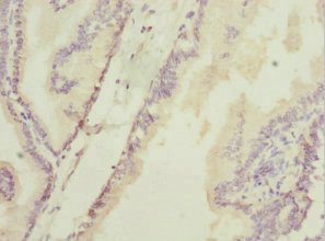 DHAND / HAND2 Antibody - Immunohistochemistry of paraffin-embedded human prostate cancer at dilution 1:100