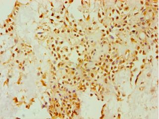 DHCR24 / Seladin-1 Antibody - Immunohistochemistry of paraffin-embedded human breast cancer using antibody at 1:100 dilution.